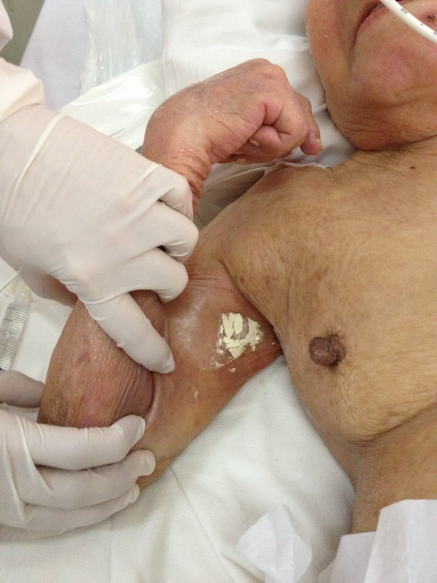 Axilla2
